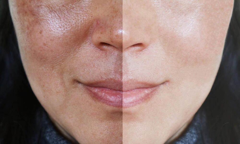 Illuminate Your Skin: The Power of Photo Facials